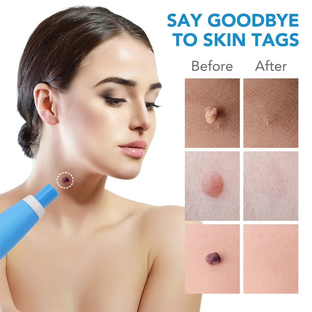 Painless Skin Tag  Removal Kit