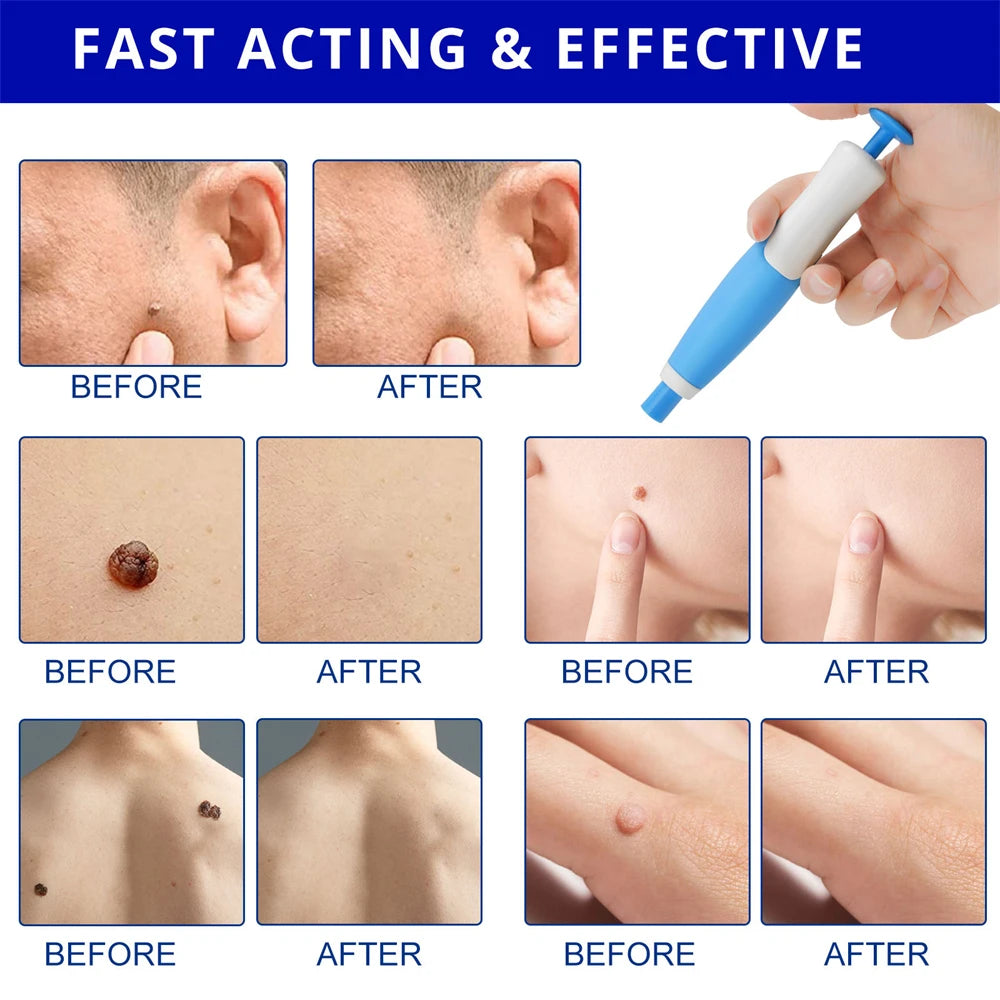Painless Skin Tag  Removal Kit